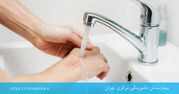 شستن زخم با آب و صابون پس از سگ گزیدگی